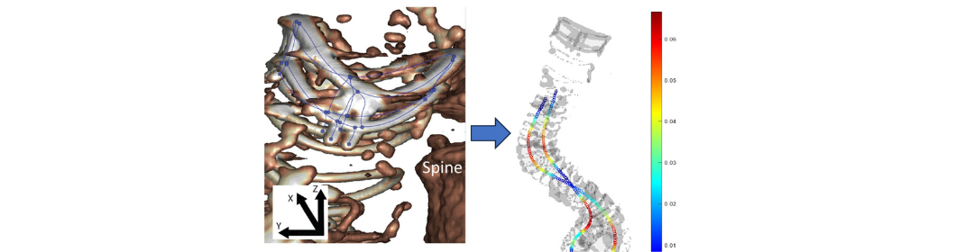 Endograft limb occlusion after endovascular repair of an abdominal aneurysm 